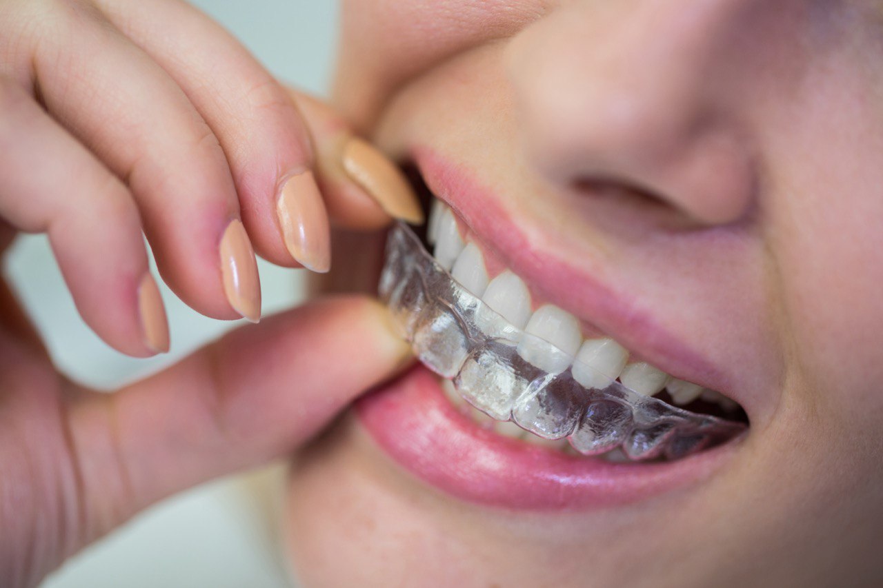 Krystal Aligners Precision